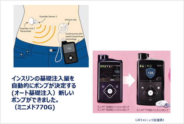 インスリン装置の選択